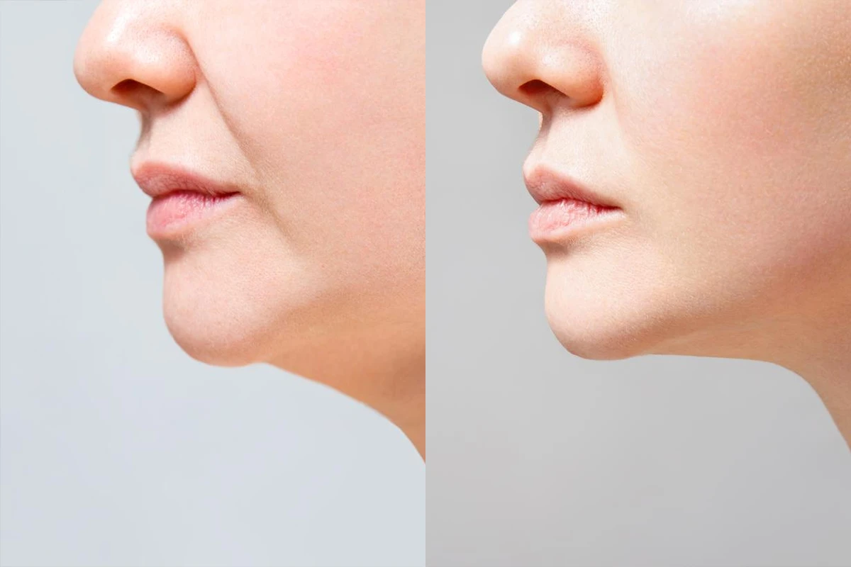Before & After jawline 1