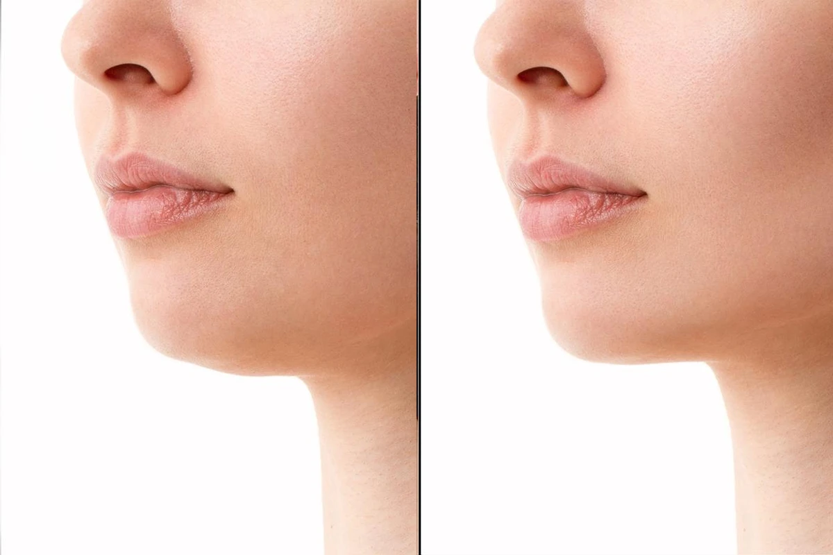Before & After jawline 2