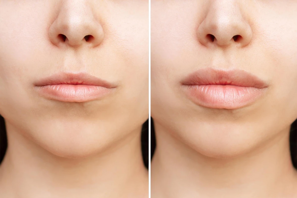 Before & After lips 1