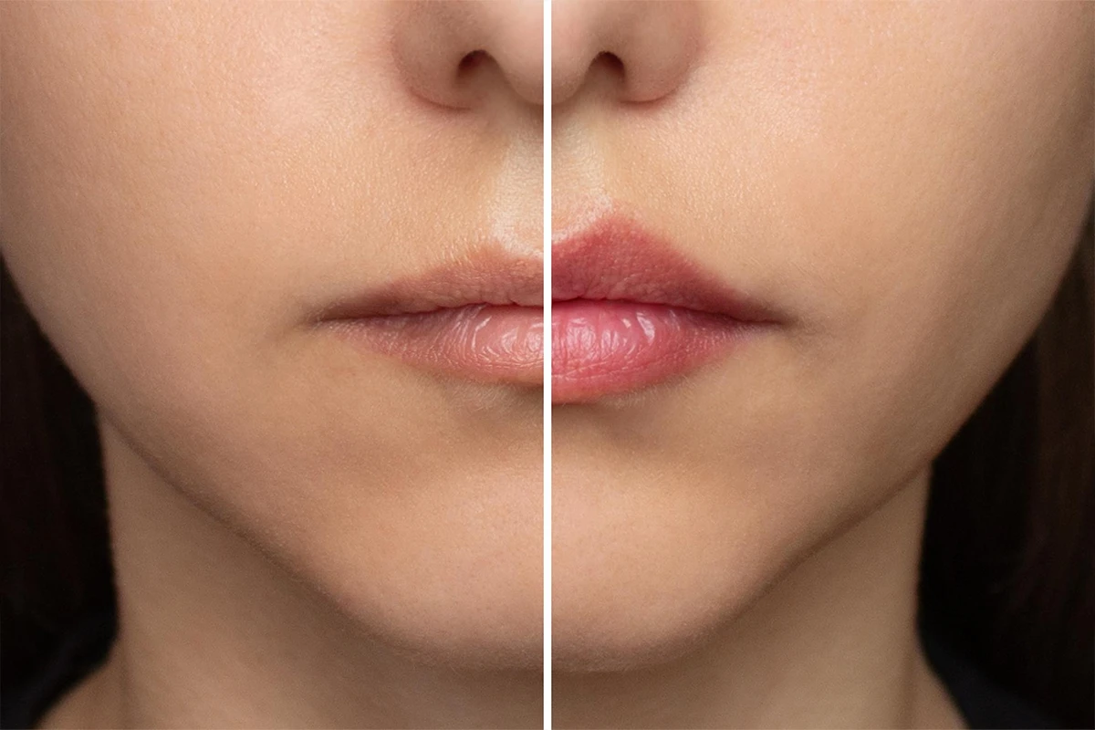 Before & After lips 2